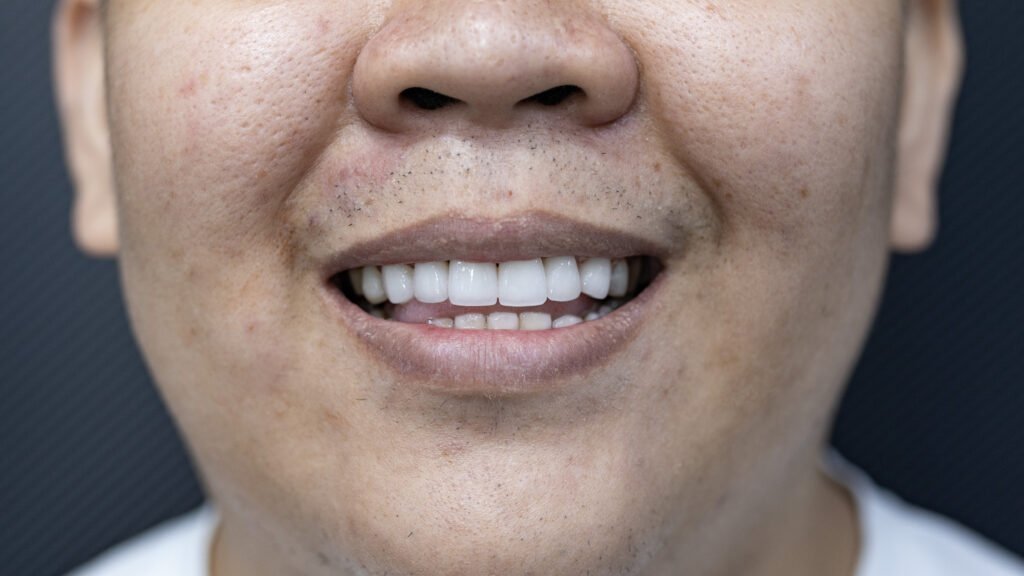 Mohd Shahrizan's Smile Makeover: A Hollywood Smile Story