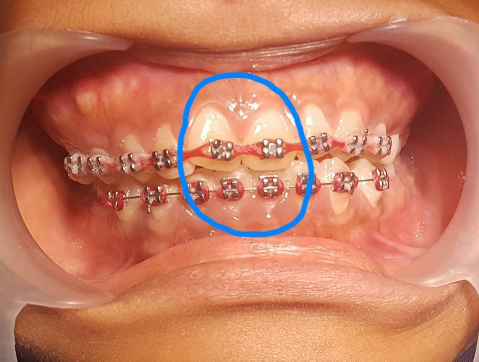 Fake Braces : The Hidden Consequences