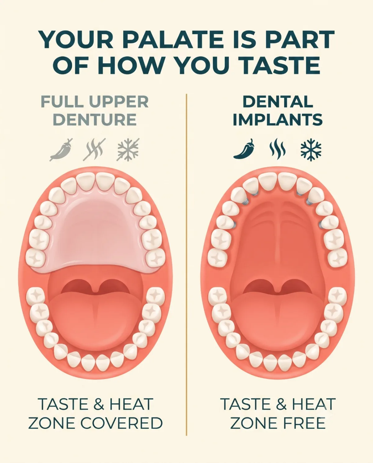 Diagram showing full upper denture covering the palate's taste and heat zone versus dental implants leaving the palate free to taste, Borneo Dental Centre Kota Kinabalu