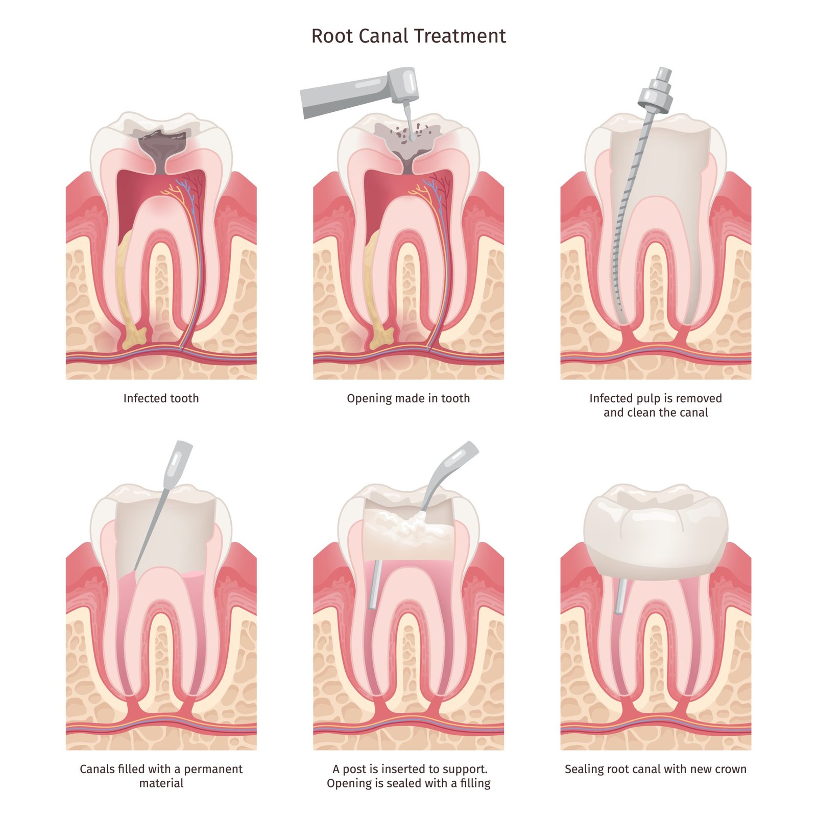 Root Canal Treatment