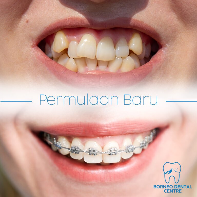 Affordable Braces: A Comprehensive Guide