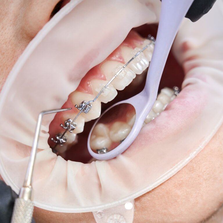 Damon Braces: The Future is Here