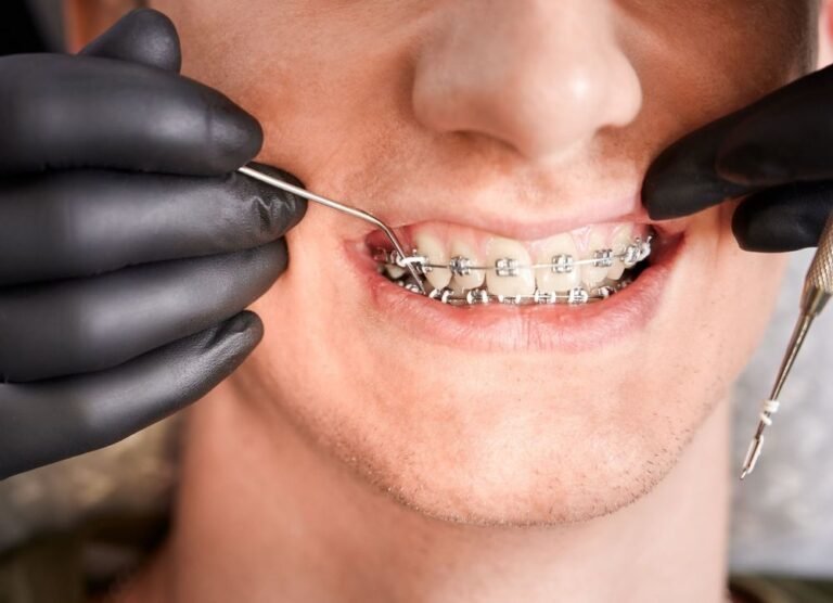 Myths of Braces: The Truth About Affordable, Painless Orthodontic Treatment