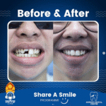 Rexcy’s Smile Journey: How Fixing a Chipped Tooth Changed His Life
