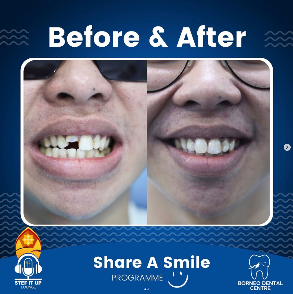 Rexcy’s Smile Journey: How Fixing a Chipped Tooth Changed His Life